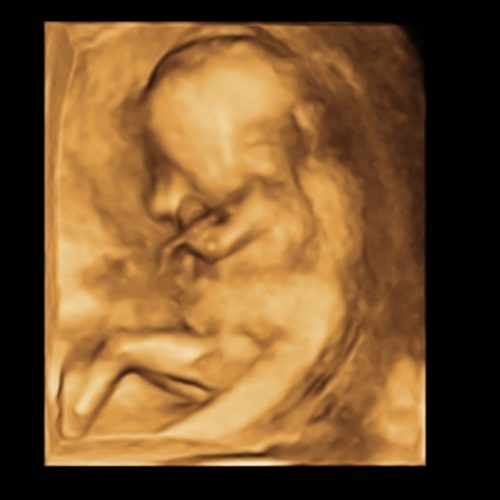 3D Ultraschall, 16. Schwangerschaftswoche